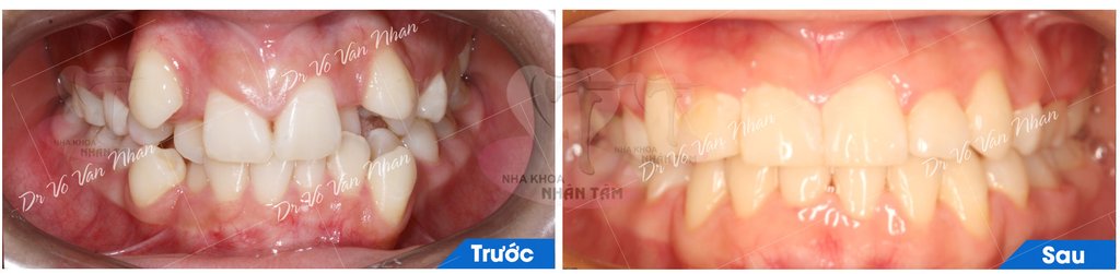 Một số trường hợp dùng lực nhẹ để chỉnh nha nhưng vẫn đạt hiệu quả cao tại Nha Khoa Nhân Tâm