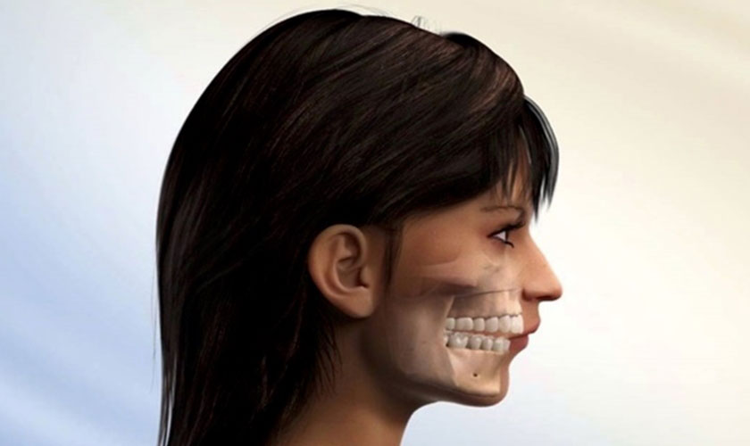 Khớp cắn hô vẩu