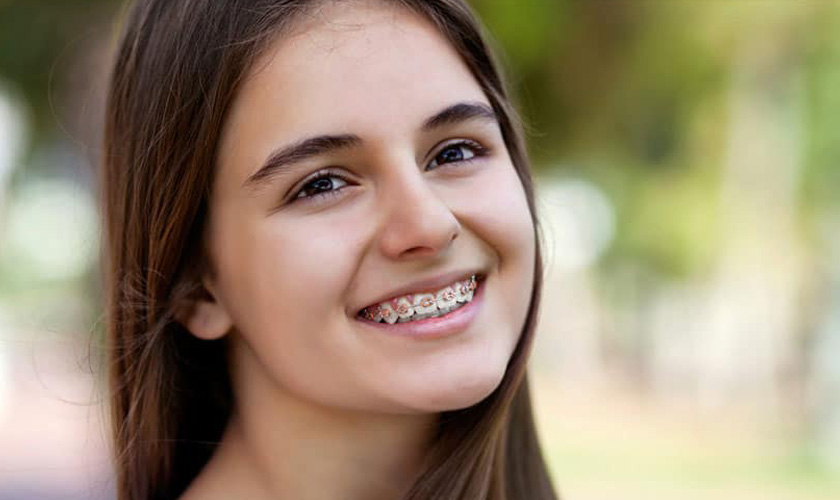 Niềng răng là một trong những giải pháp điều trị sai khớp cắn hiệu quả