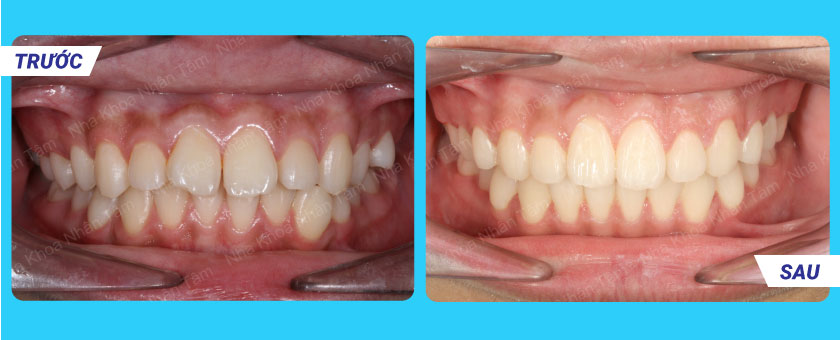 Khách hàng niềng răng điều trị sai lệch khớp cắn tại Nha khoa Nhân Tâm