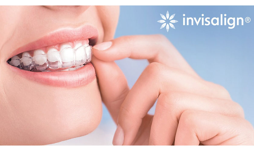 Câu hỏi thường gặp về niềng răng không mắc cài Invisalign
