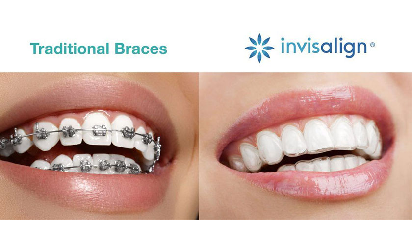 Không như kỹ thuật niềng răng mắc cài, khay niềng Invisalign có thể dễ dàng tháo lắp để sinh hoạt và ăn uống một cách bình thường    