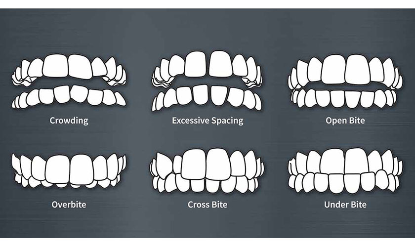 Những trường hợp sai lệch khớp cắn nhẹ có thể niềng răng Invisalign    