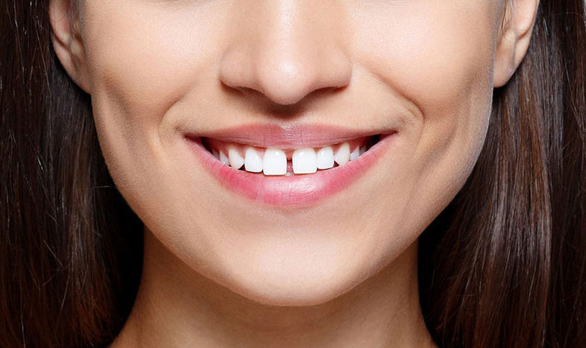 Niềng răng cửa thưa mất bao nhiêu tiền?