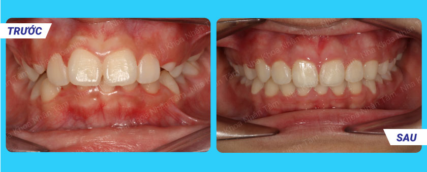 Kết quả điều trị niềng răng của Khách hàng 2