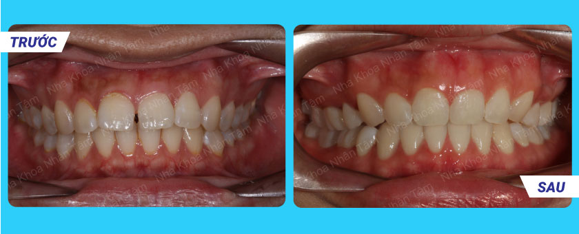 Kết quả điều trị niềng răng của Khách hàng 3