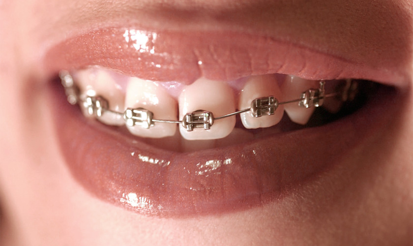 Niềng răng – Giải pháp làm đẹp răng số 1 hiện nay