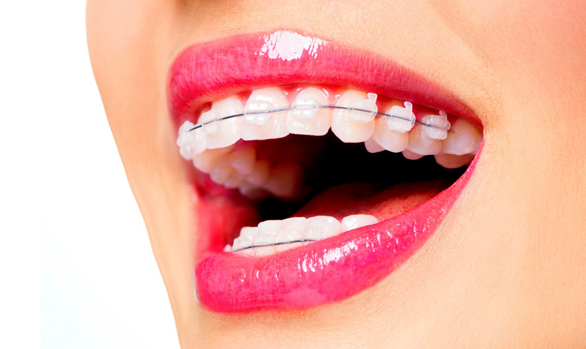 Niềng răng – Giải pháp làm đẹp răng số 1 hiện nay