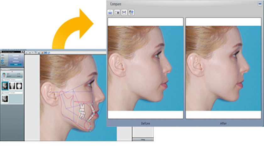Phần mềm chỉnh nha (niềng răng) OrthoVison tại Nha khoa Nhân Tâm