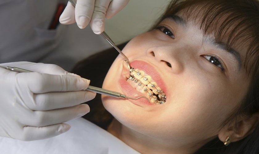 Bệnh nhân sẽ được thăm khám, tư vấn cụ thể trước khi tiến hành niềng răng