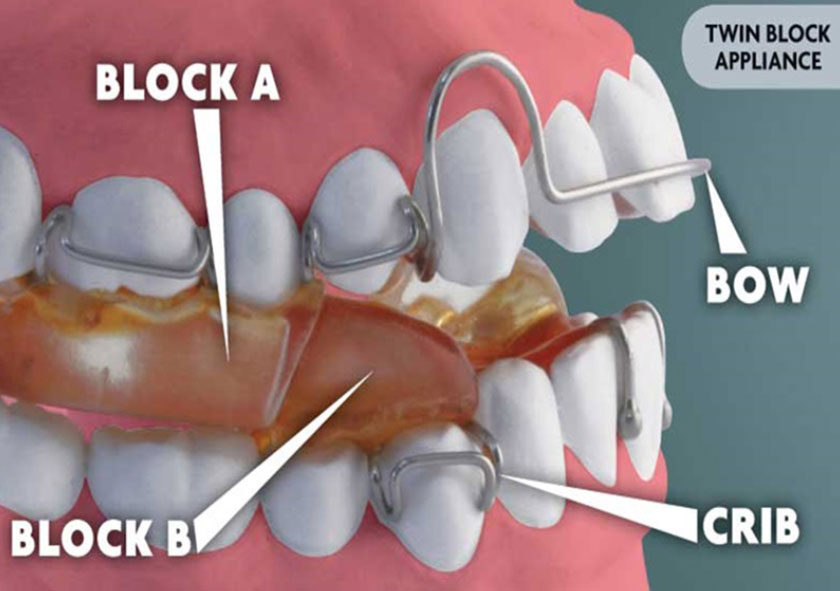 Kết quả và phương pháp có thể thay đổi khi niềng răng