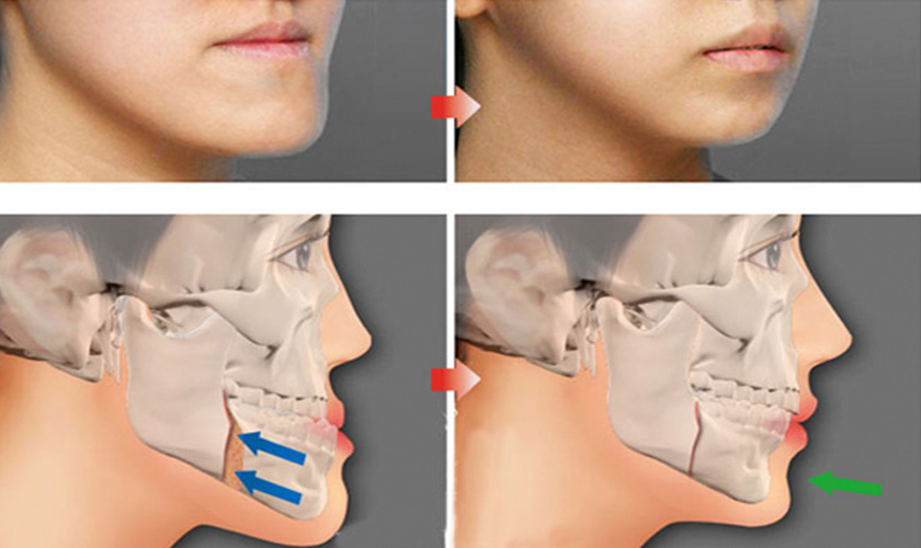 Móm răng dẫn đến nhiều hệ lụy khác nhau, ảnh hưởng rất nhiều đến cuộc sống của bệnh nhân