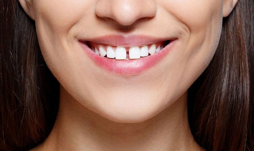 Niềng răng thưa mất bao lâu để răng đều đẹp?