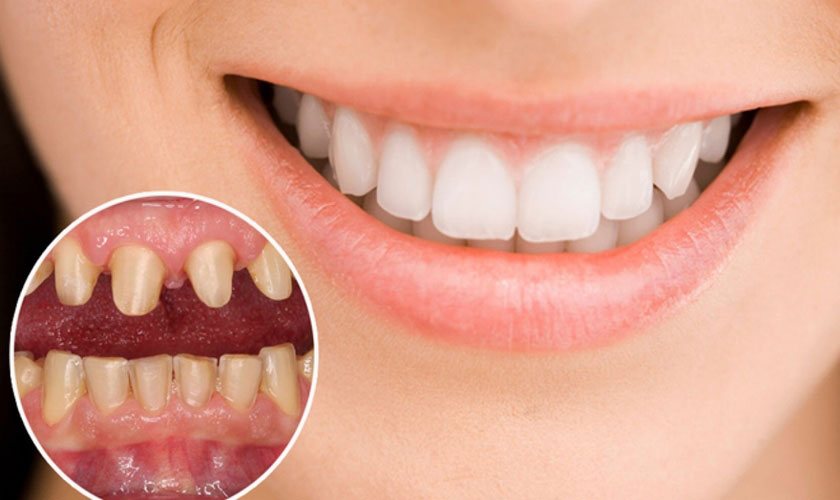 Bọc răng sứ khắc phục răng thưa