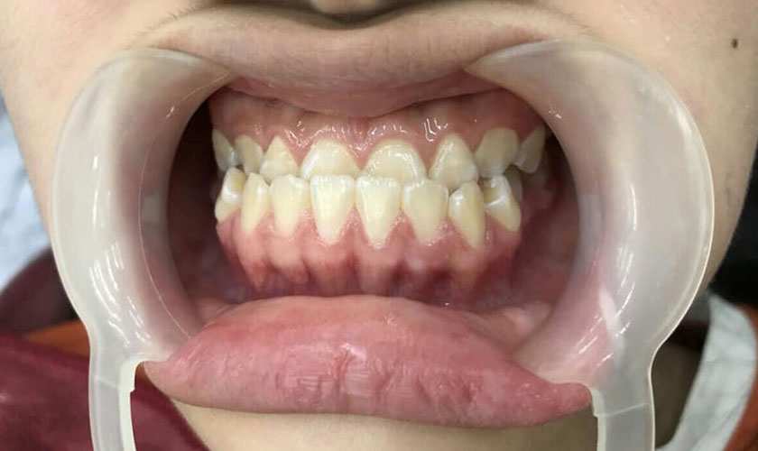 Tiết lộ những sự thật cần biết trước khi niềng răng móm