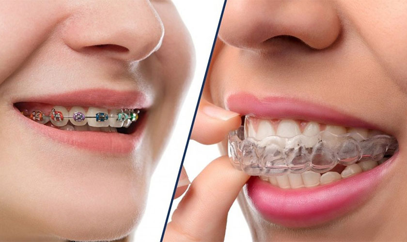 Niềng răng mắc cài và niềng răng Invisalign