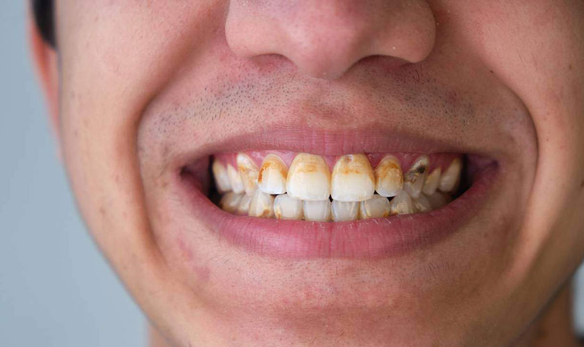 Vôi răng ảnh hưởng đến thẩm mỹ và sức khỏe răng miệng