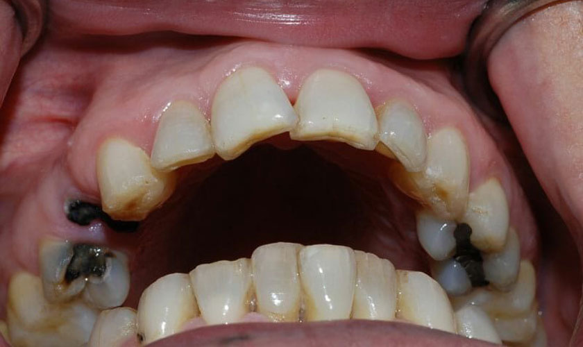 Sử dụng thuốc giảm đau răng cần tham khảo ý kiến của bác sĩ