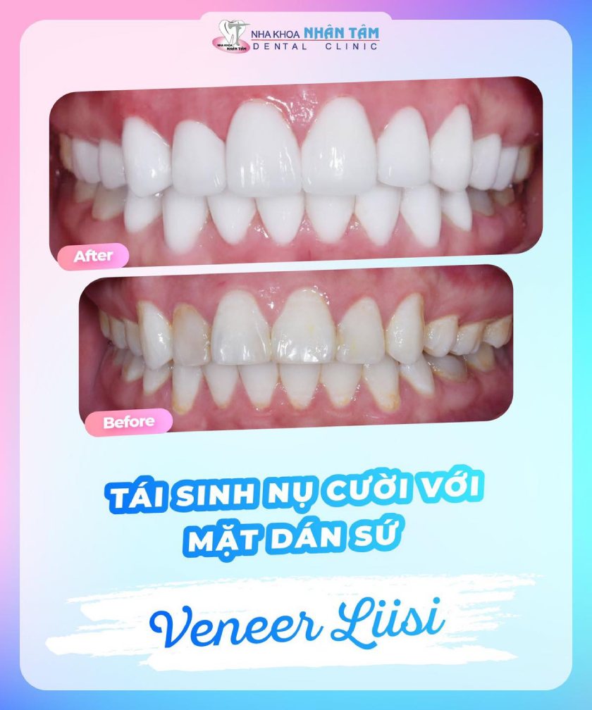 Nụ cười của khách hàng N.T.M.A sau khi dán sứ Veneer Liisi