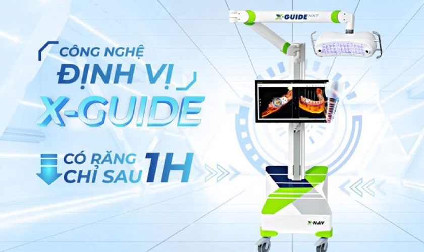 Hệ thống định vị X-Guide NXT