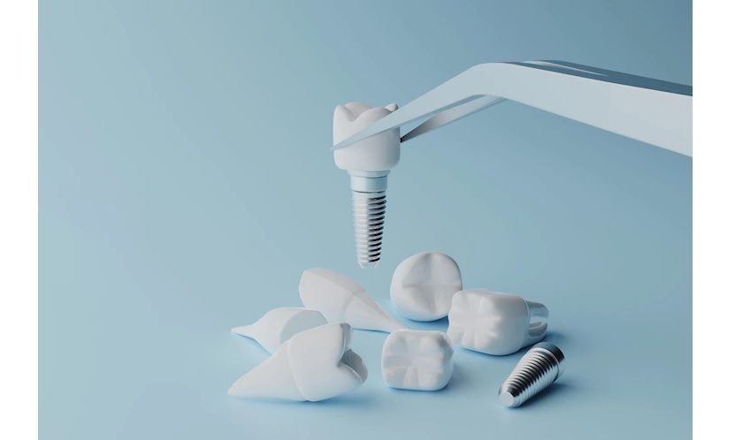 Phục hình răng bằng phương pháp cấy ghép implant