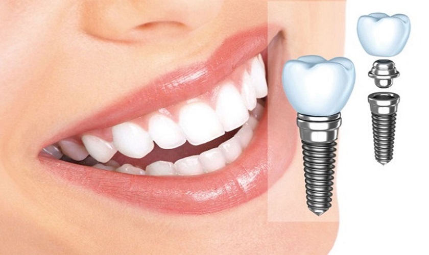 Bảng giá cấy ghép implant chuyên sâu tại Nha khoa Nhân Tâm