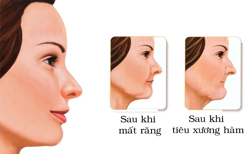 Những hậu quả khi bị mất răng