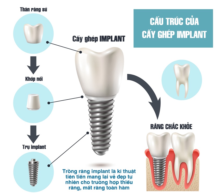 Cấu tạo một chiếc răng implant