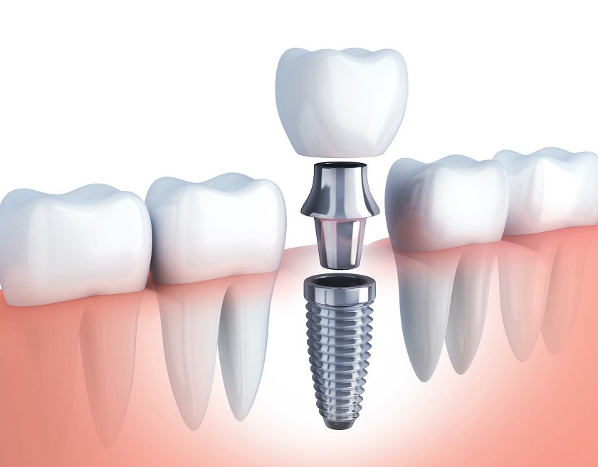 Trụ implant