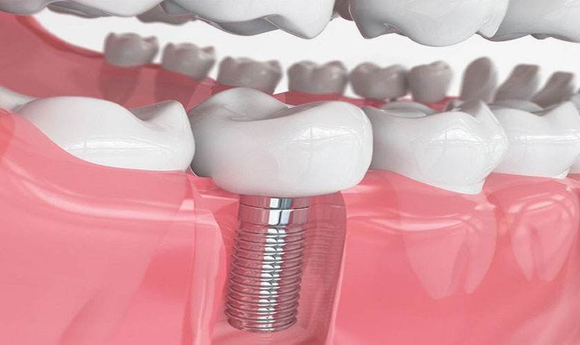 Implant - Giải pháp tối ưu khi bị mất răng số 7