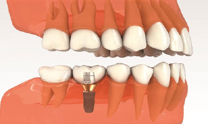 Implant - Giải pháp tối ưu khi bị mất răng số 6