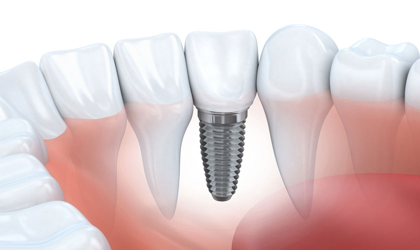 Cấy ghép răng Implant phục hình răng số 6 hiệu quả Cấy ghép răng Implant phục hình răng số 6 hiệu quả