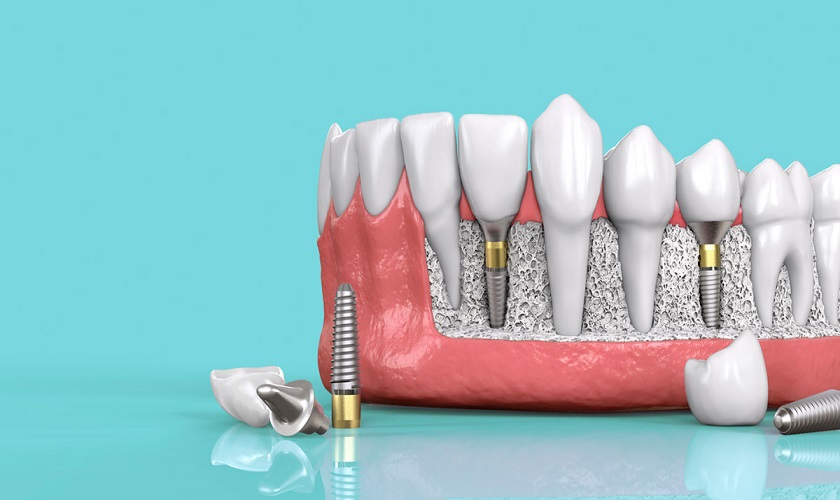 Dịch vụ trồng răng implant bao nhiêu tiền?