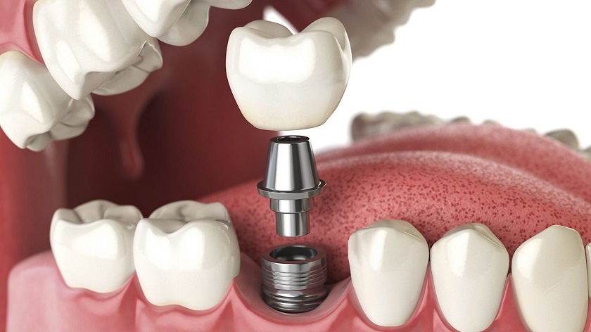 Phương pháp cấy ghép implant