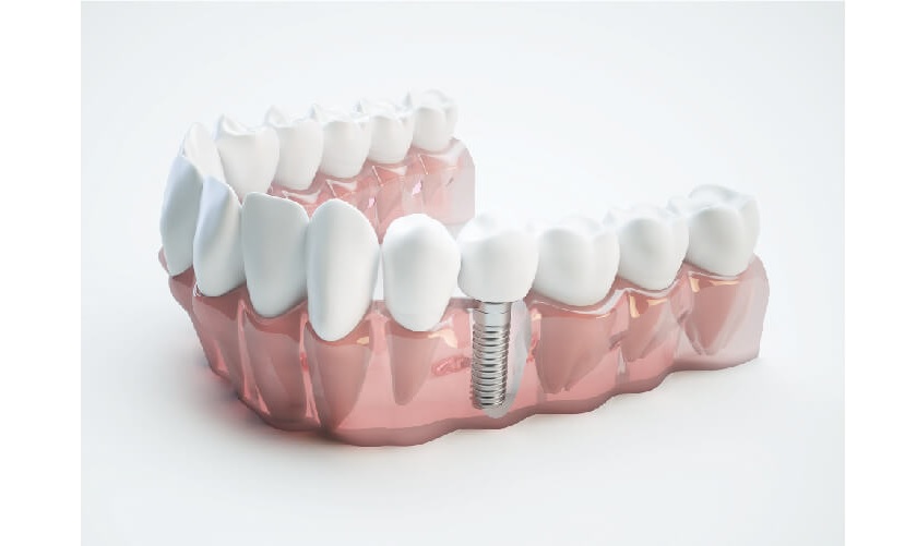 Cấy ghép implant là phương pháp được tiến hành cho tất cả các trường hợp