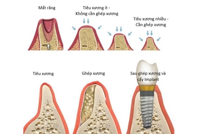 Ghép xương hàm được xem là kỹ thuật tiến bộ vượt bậc trong việc điều trị nha khoa.