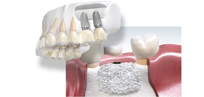 Điều kiện để cấy ghép xương hàm trong trồng răng implant là gì?
