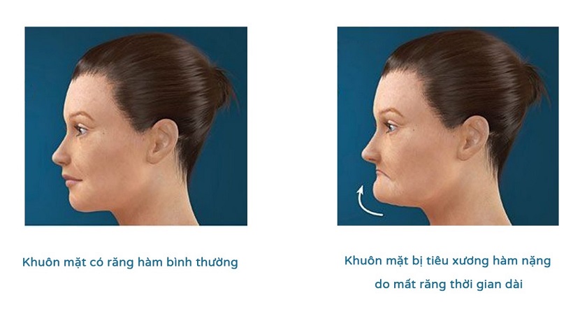 Cấy ghép xương hàm giúp giữ lại sự tươi trẻ của khuôn mặt