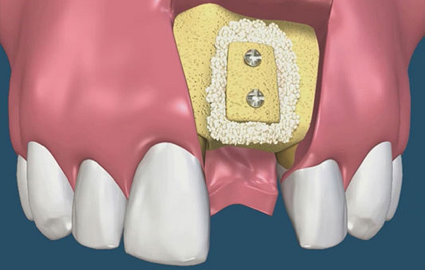 Các nguyên nhân dẫn đến tiêu xương răng