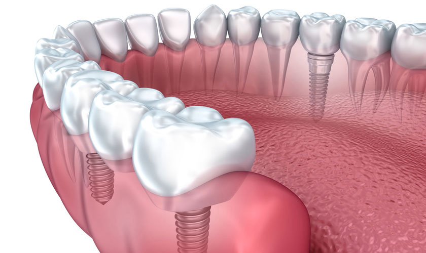 Những điều cần lưu ý về trồng răng implant