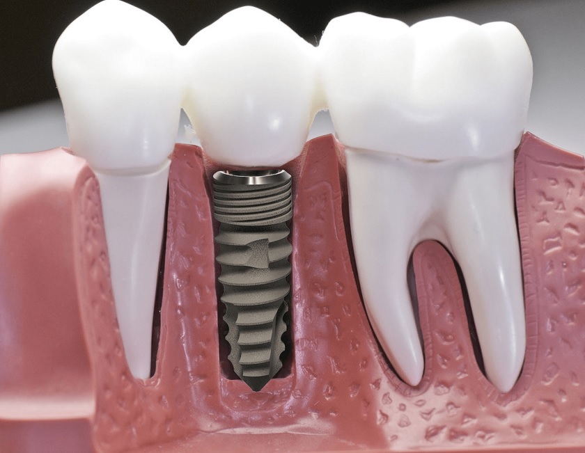 Sức khỏe cần phải đảm bảo khỏe mạnh để tăng thành công khi trồng răng implant