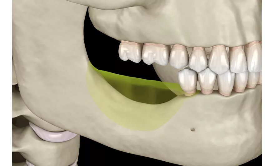 Những nguyên nhân gây tiêu xương chân răng là gì?