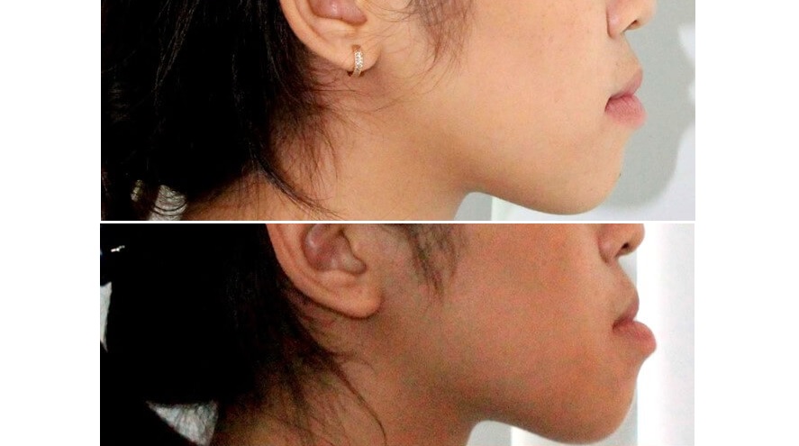 Những hậu quả của tiêu xương chân răng