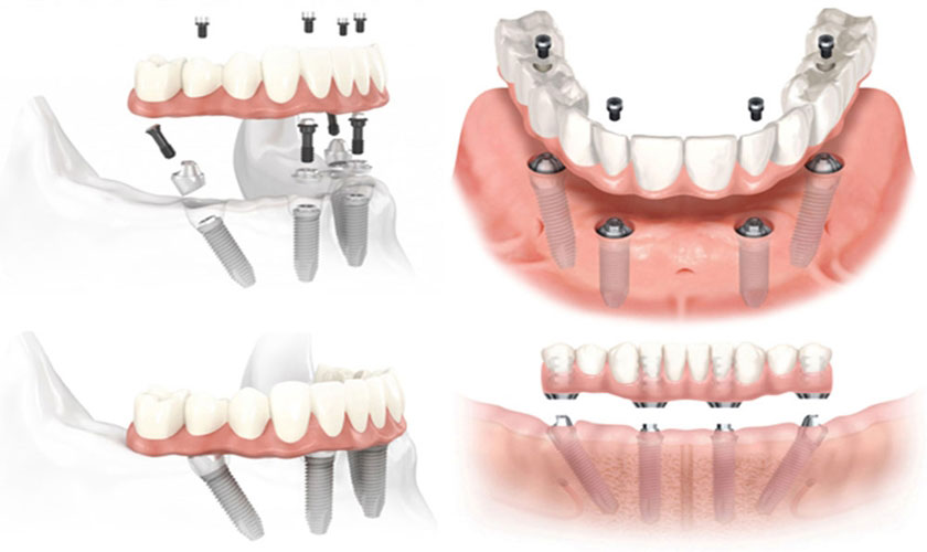 Hàm giả tháo lắp Implant: Giải pháp trồng răng tiết kiệm