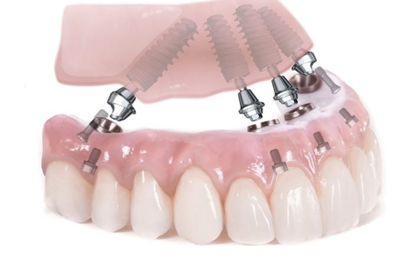 Trụ Implant được chế tác từ hỗn hợp Titanium