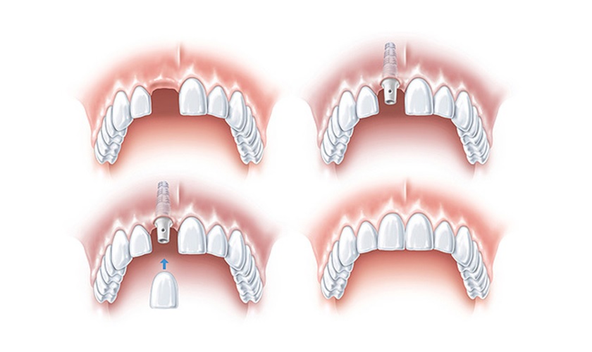 Quá trình cấy ghép implant tại Nha khoa Nhân Tâm