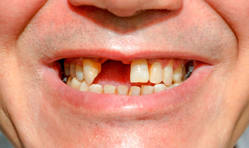 Gãy răng cửa: Giải pháp nào để khắc phục hiệu quả, thẩm mỹ?