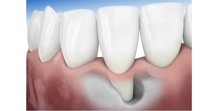 Khách hàng cần đảm bảo sức khỏe răng miệng trước khi tiến hành cấy ghép implant
