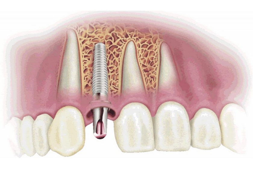 Sau cấy ghép implant, bạn nên chú ý chế độ ăn uống để vết thương nhanh chóng phục hồi