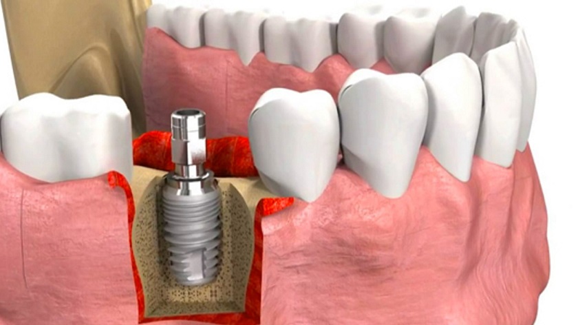 Trụ implant cần đặt đúng vị trí cần chỉ định